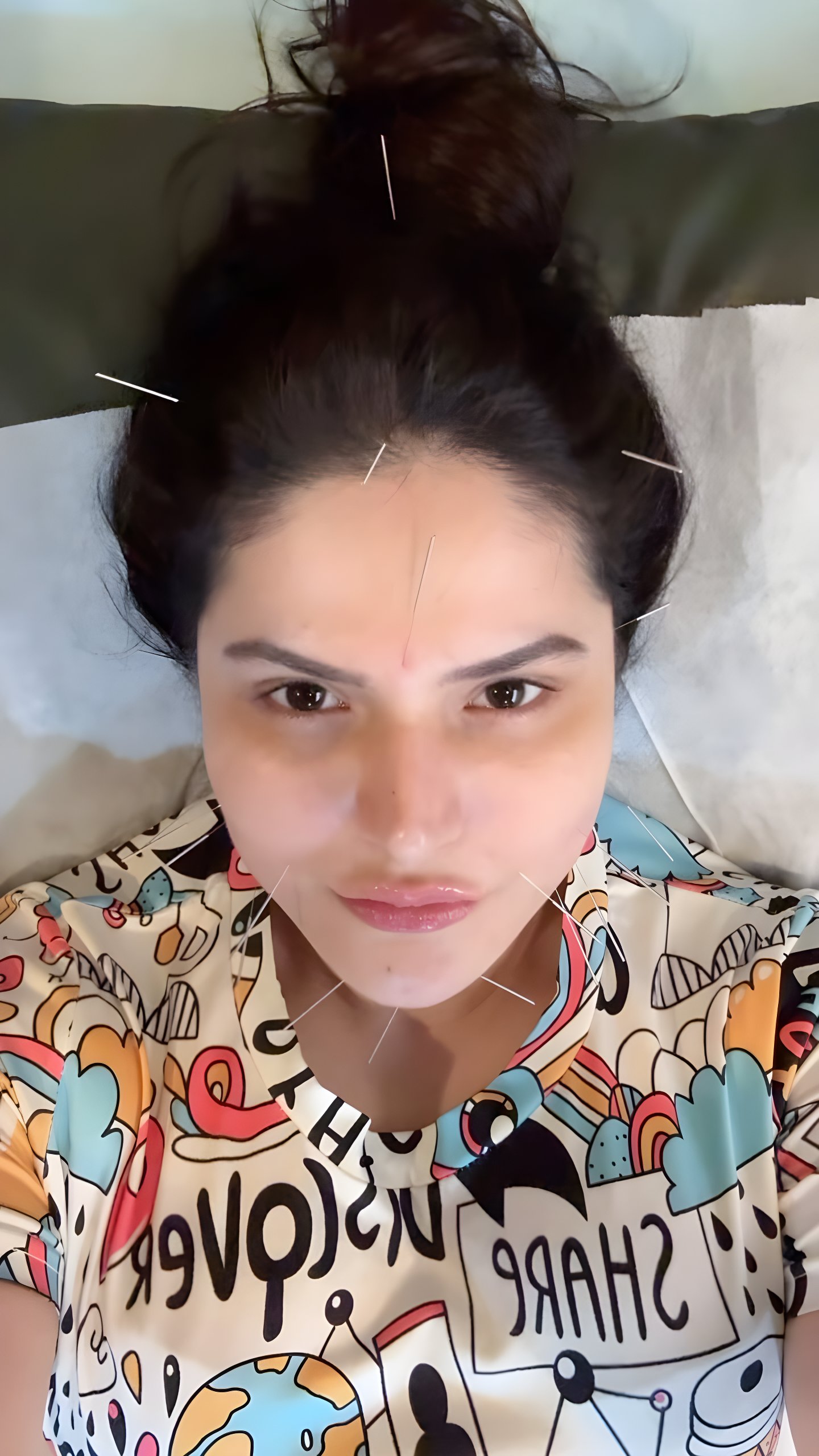 Zareen Khan Shares Comprehensive Guide To Acupuncture Benefits For Wellness And Beauty Zareen Khan Shares Comprehensive Guide To Acupuncture Benefits For Wellness And Beauty
